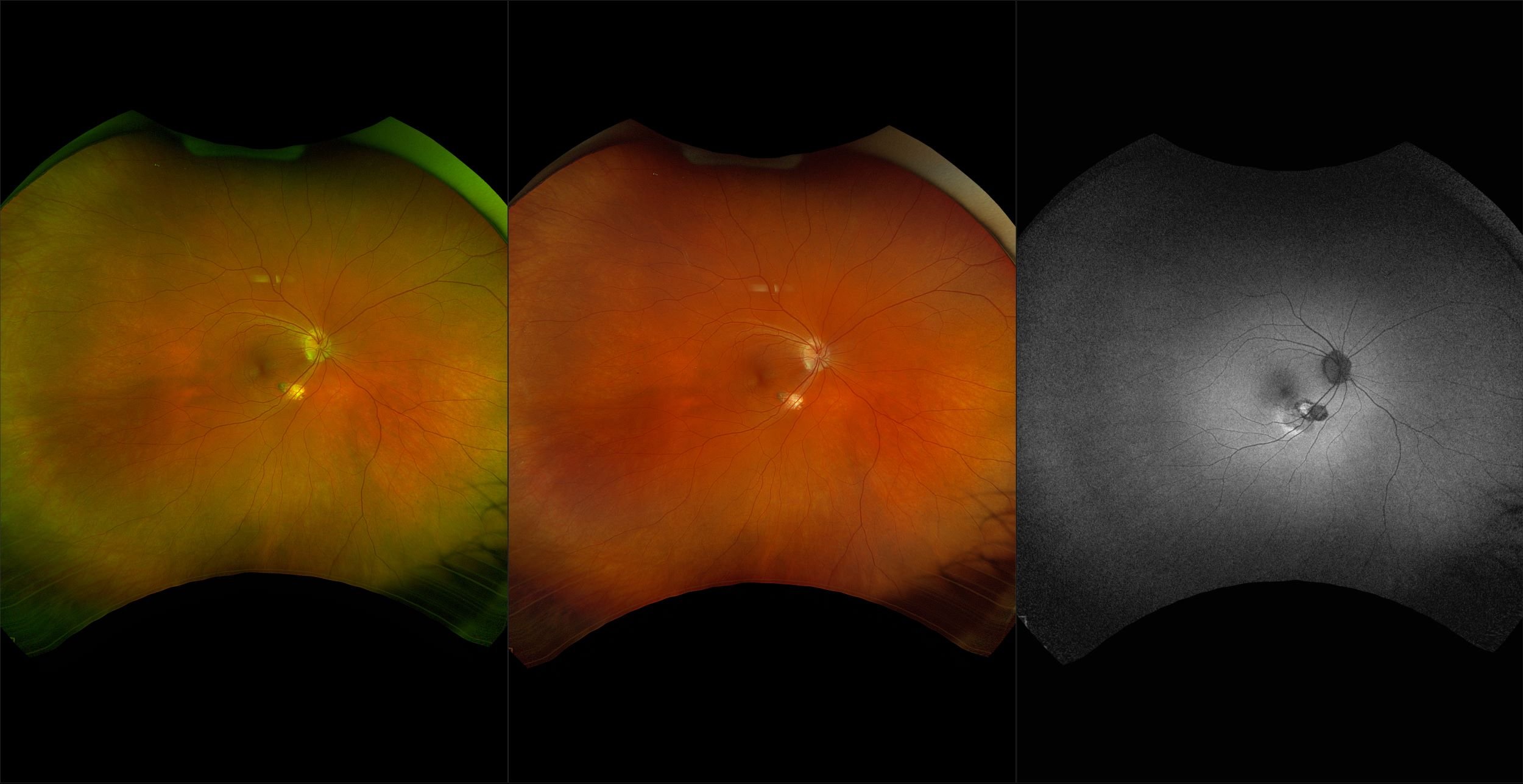 California - Idiopathic Macular Neovascularization, RG, RGB, BAF