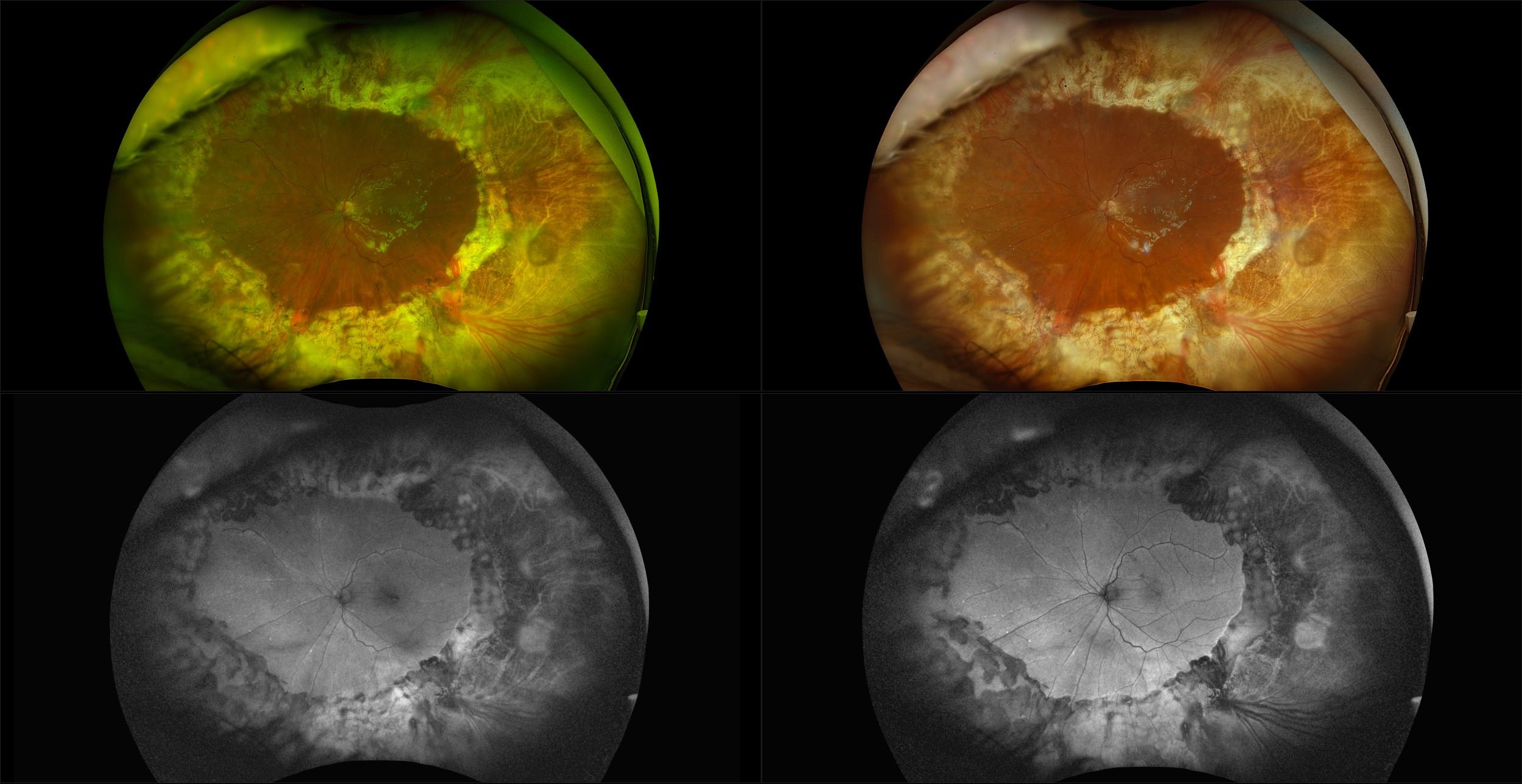 California - Inactive Acute Retinal Necrosis, RG, RGB, AF, BAF