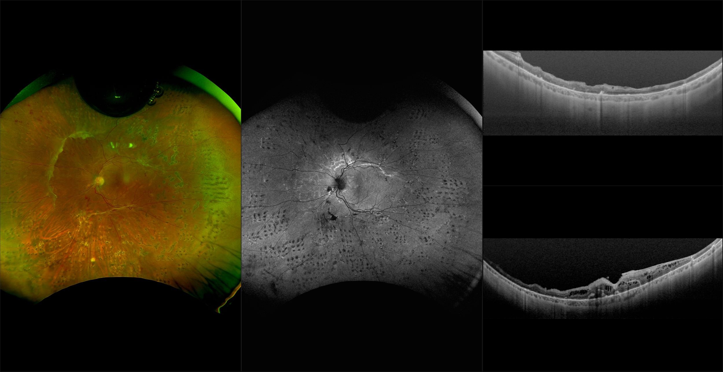 Silverstone - Tractional Retinal Detachment with Silicone Oil, RG, AF, OCT