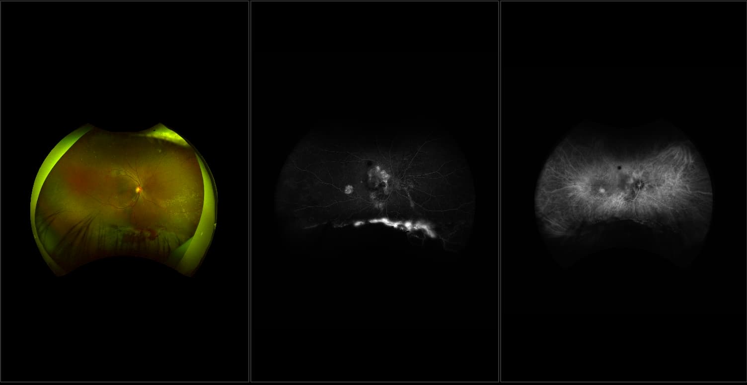 California - Central Serous Chorioretinopathy with Possible Vasculitis, RG, FA, ICG
