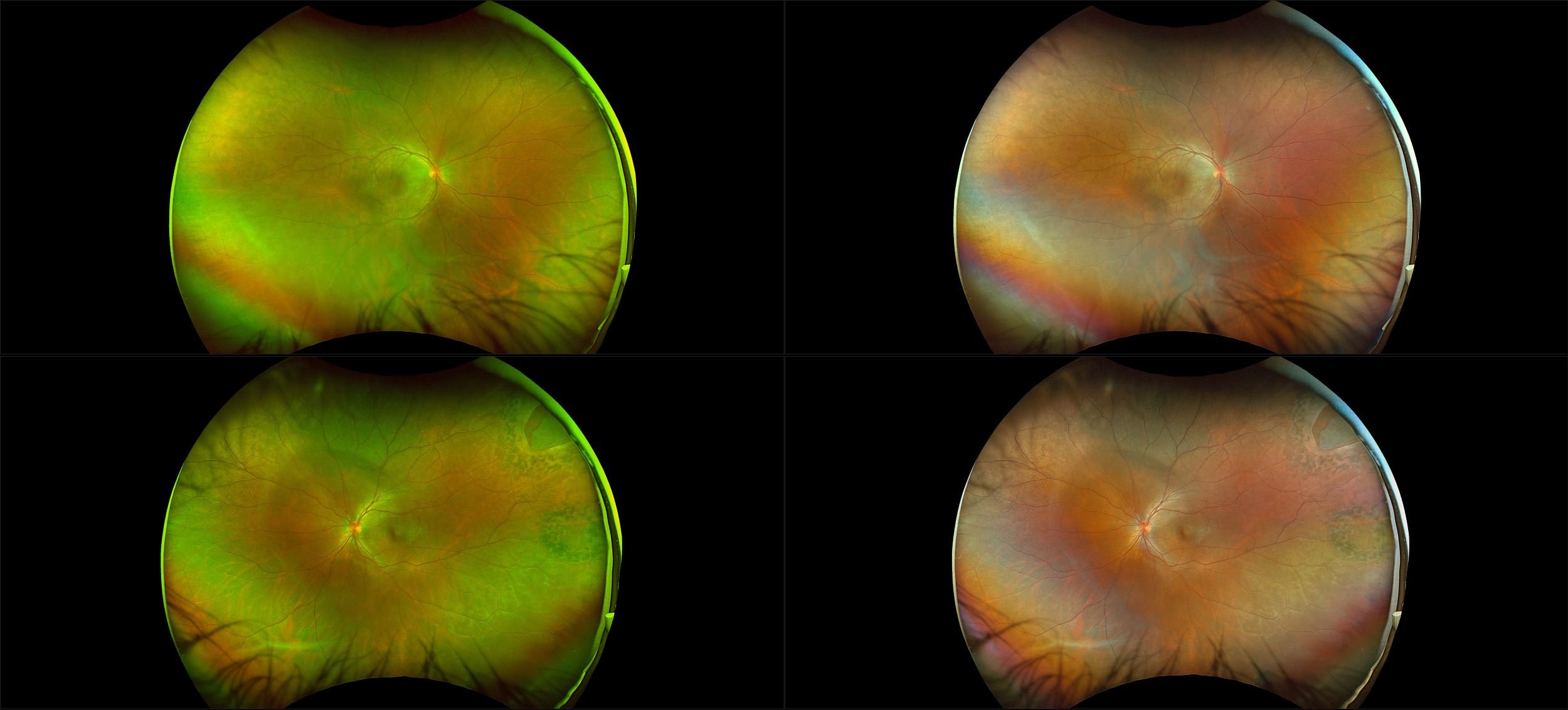 California - Retinal Tear with Posterior Uveitis, RG, RGB