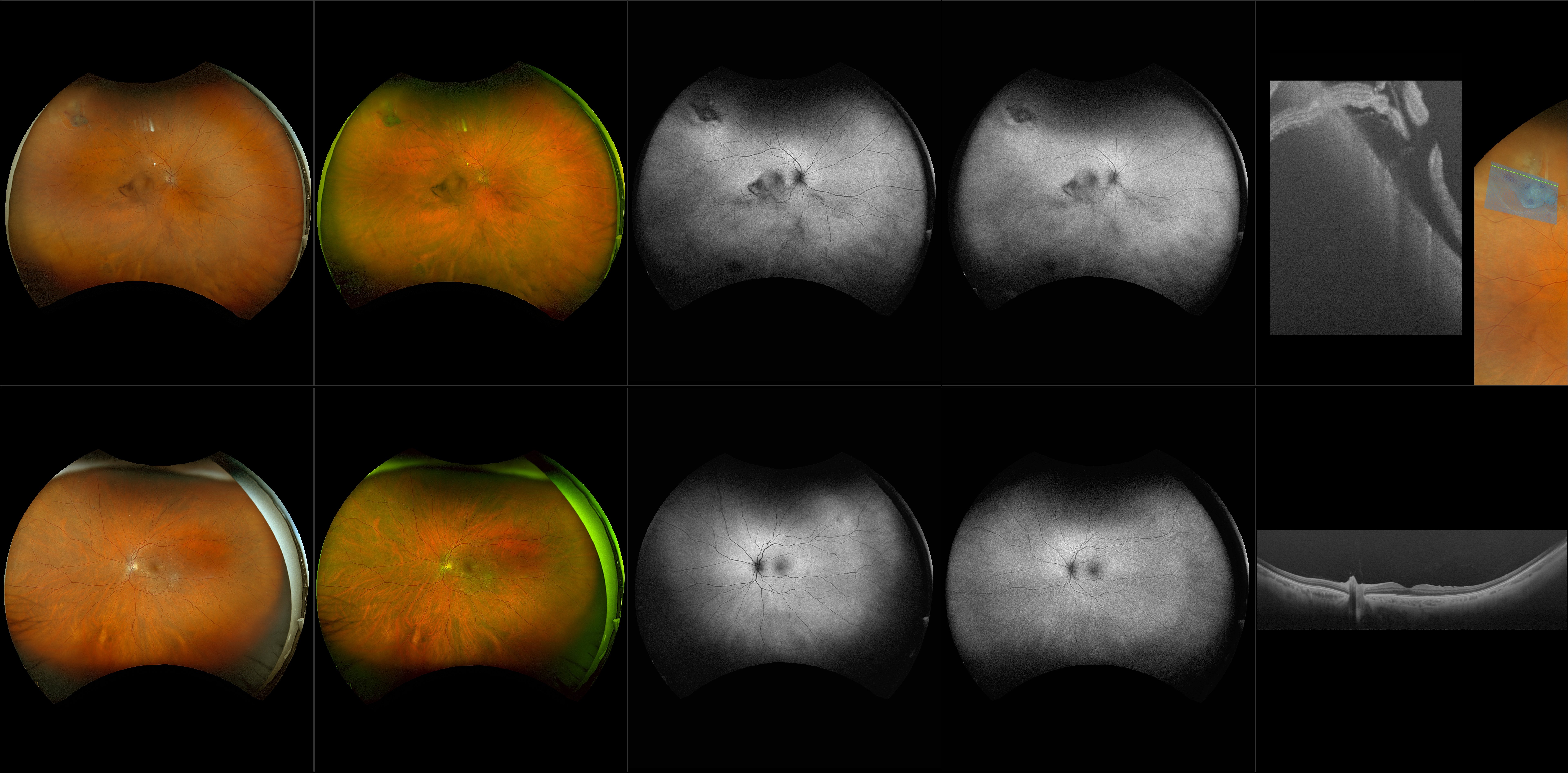 Silverstone - Retinal Tear with Vitreous Hemorrhage (OD), Epiretinal Membrane (OS),2+ Nuclear Scleroris Cataract (OU) - RG, RGB, AF, BAF, OCT - Line, UWF Line, Raster, Retina, Navigated Line, Navigated Volume