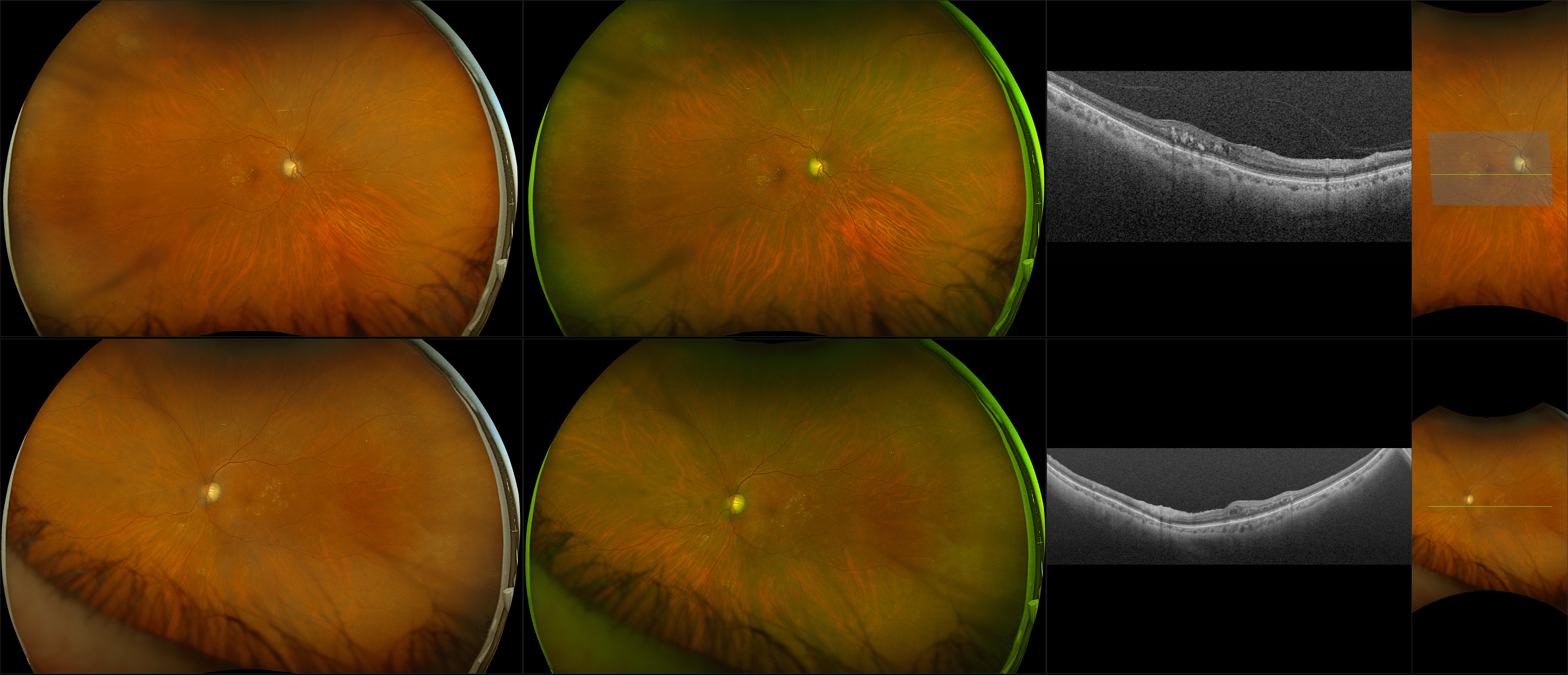 Silverstone - Mild Nonproliferative Diabetic Retinopathy, Mild Glaucoma, 2+ Nuclear Sclerosis Cataract (OU) - RG, RGB, OCT - Line, UWF Line, Raster, ONH, Navigated Line