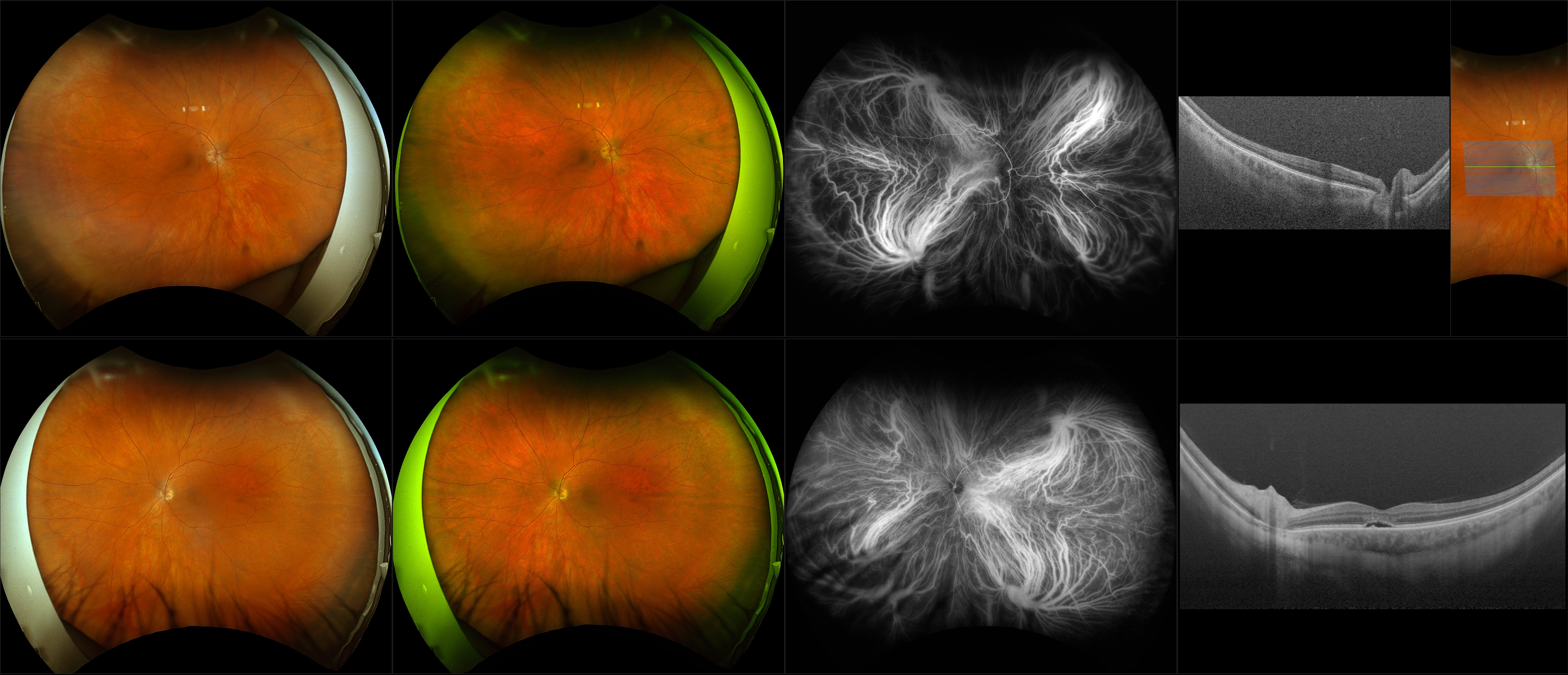 Silverstone - Central Serous Chorioretinopathy (CSR) (OS) - RG, RGB, ICG, OCT - Line, UWF Line, Raster, Retina