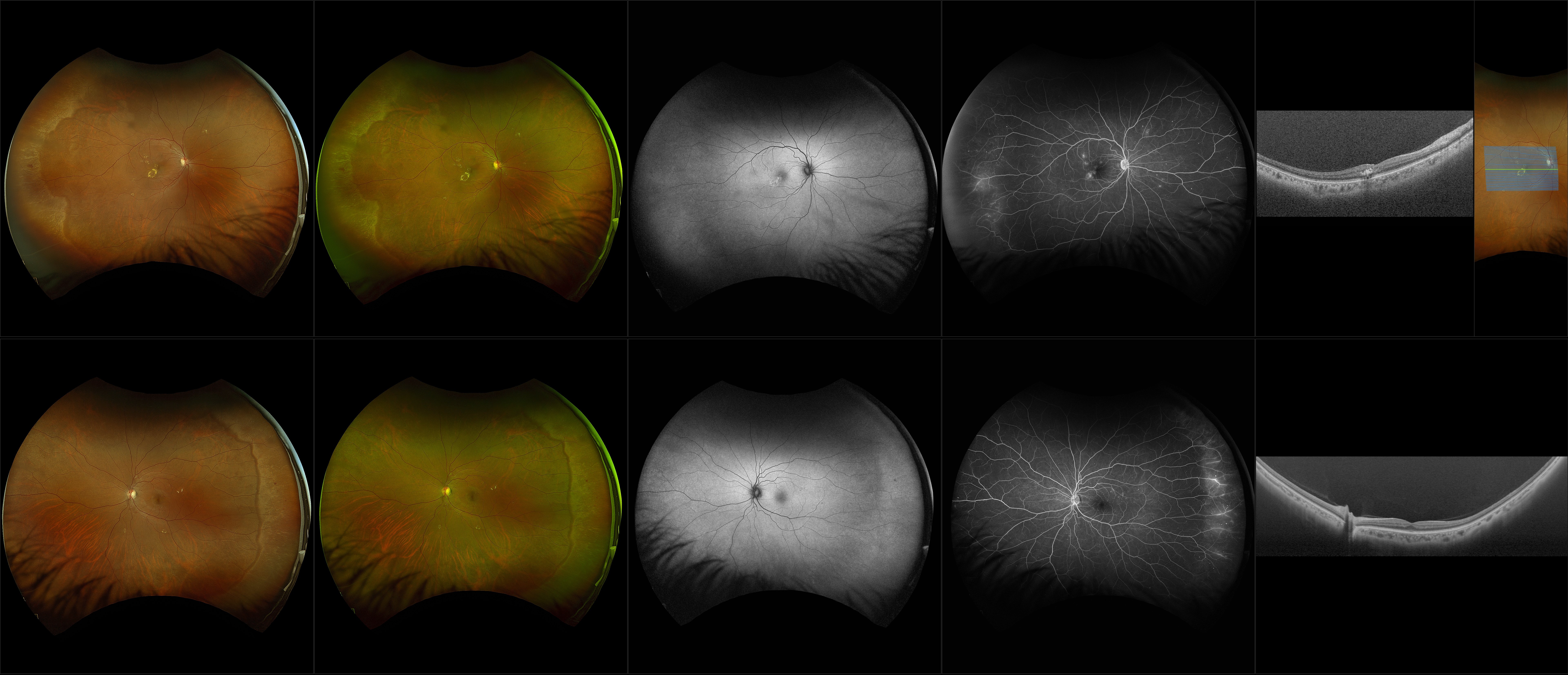 Silverstone - Moderate Nonproliferative Diabetic Retinopathy, Lattice Degeneration, White Without Pressure (OU) - RG, RGB, AF, FA, OCT - Line, UWF Line, Raster, Retina, Navigated Line, Navigated Volume