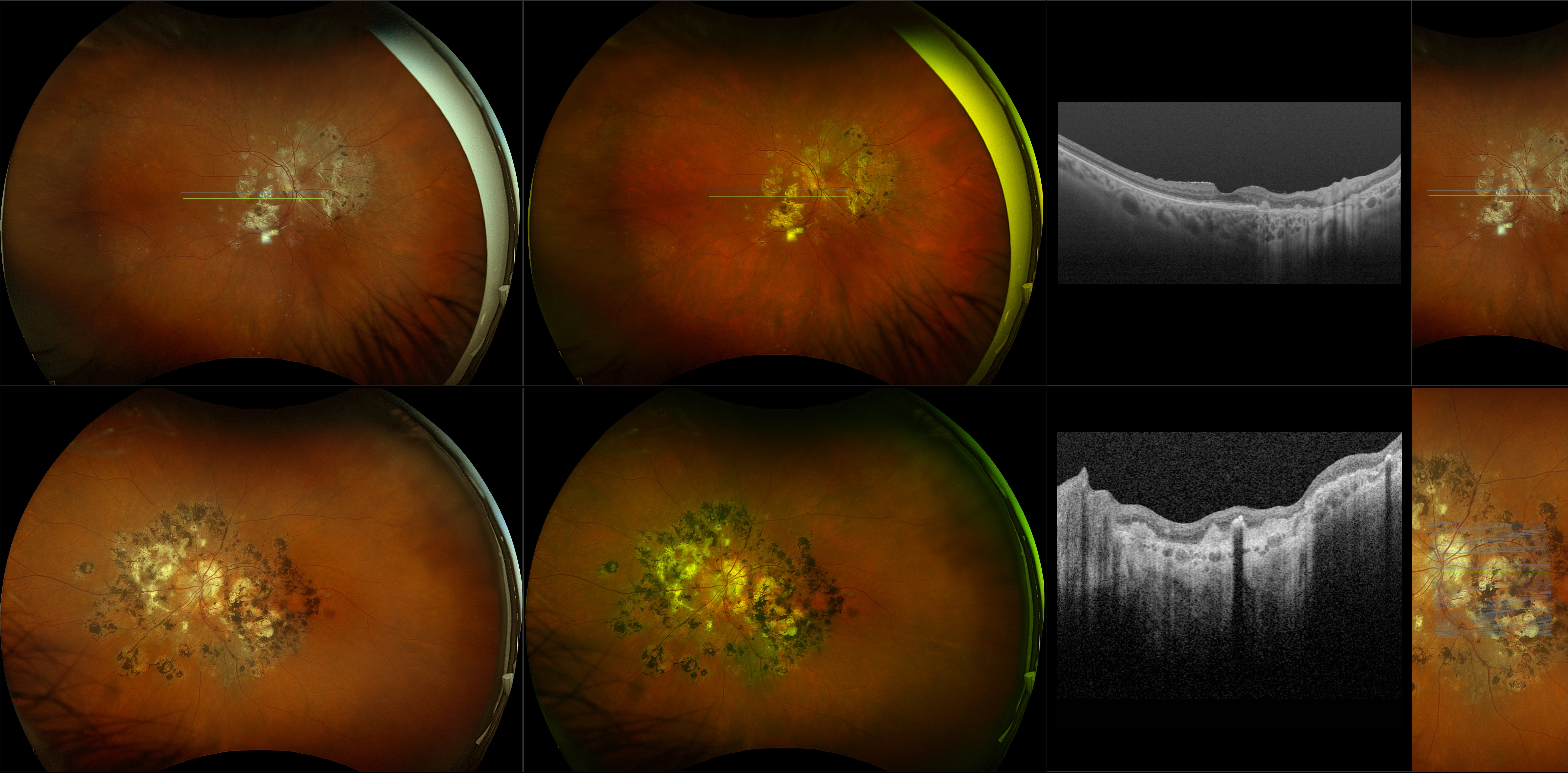 Silverstone - Multifocal Choroiditis with Macular Neovascularization, Posterior Vitreous Detachment (OU) - RG, RGB, OCT - Line, UWF Line, Raster, Retina