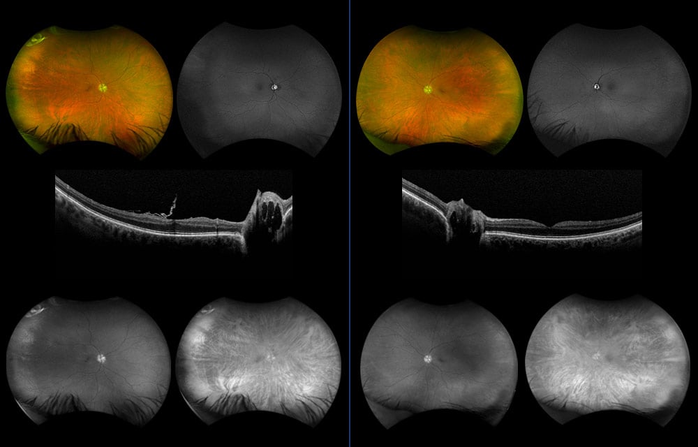 MonacoPro Galucoma Case