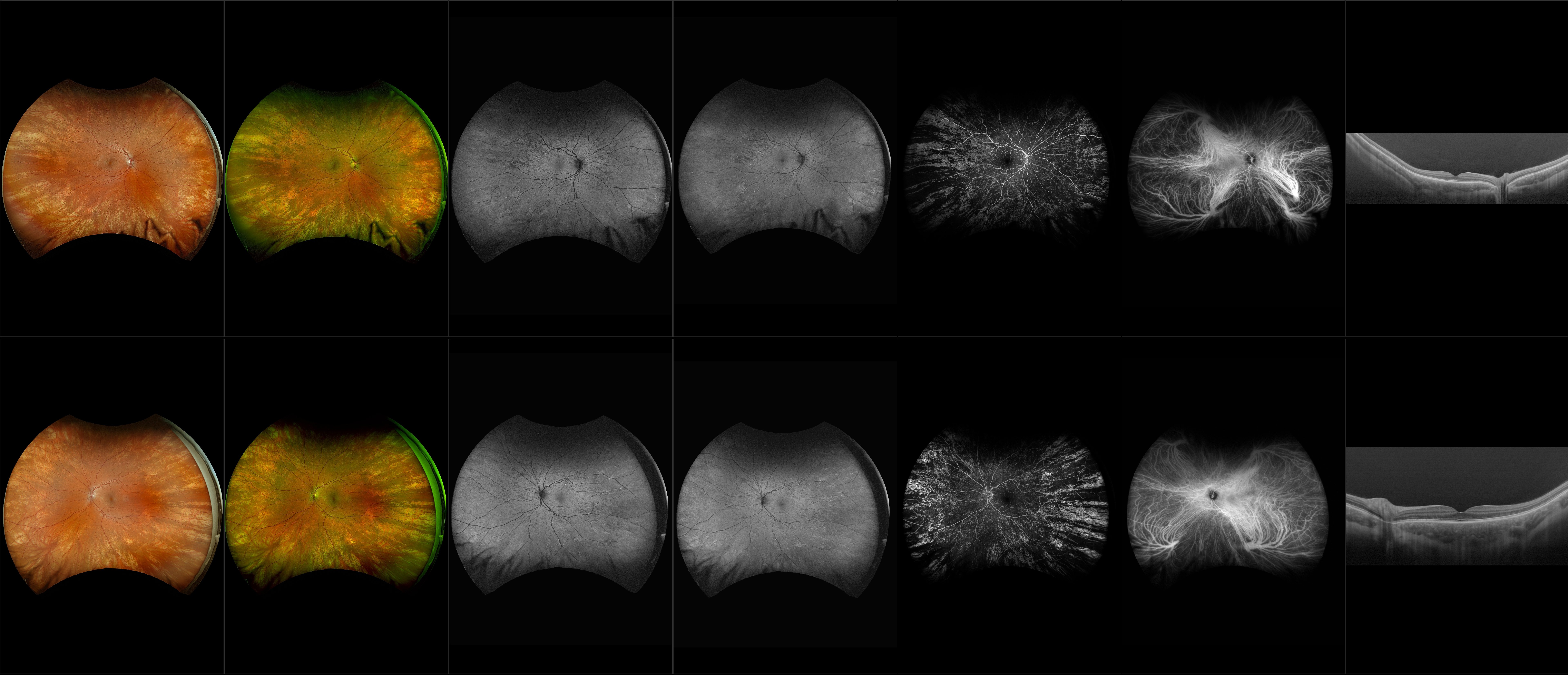 Silverstone - Peripheral Retinal Degeneration (OU) - RG, RGB, AF, BAF, FA, ICG, OCT - Line, UWF Line, Raster, Retina, Navigated Volume