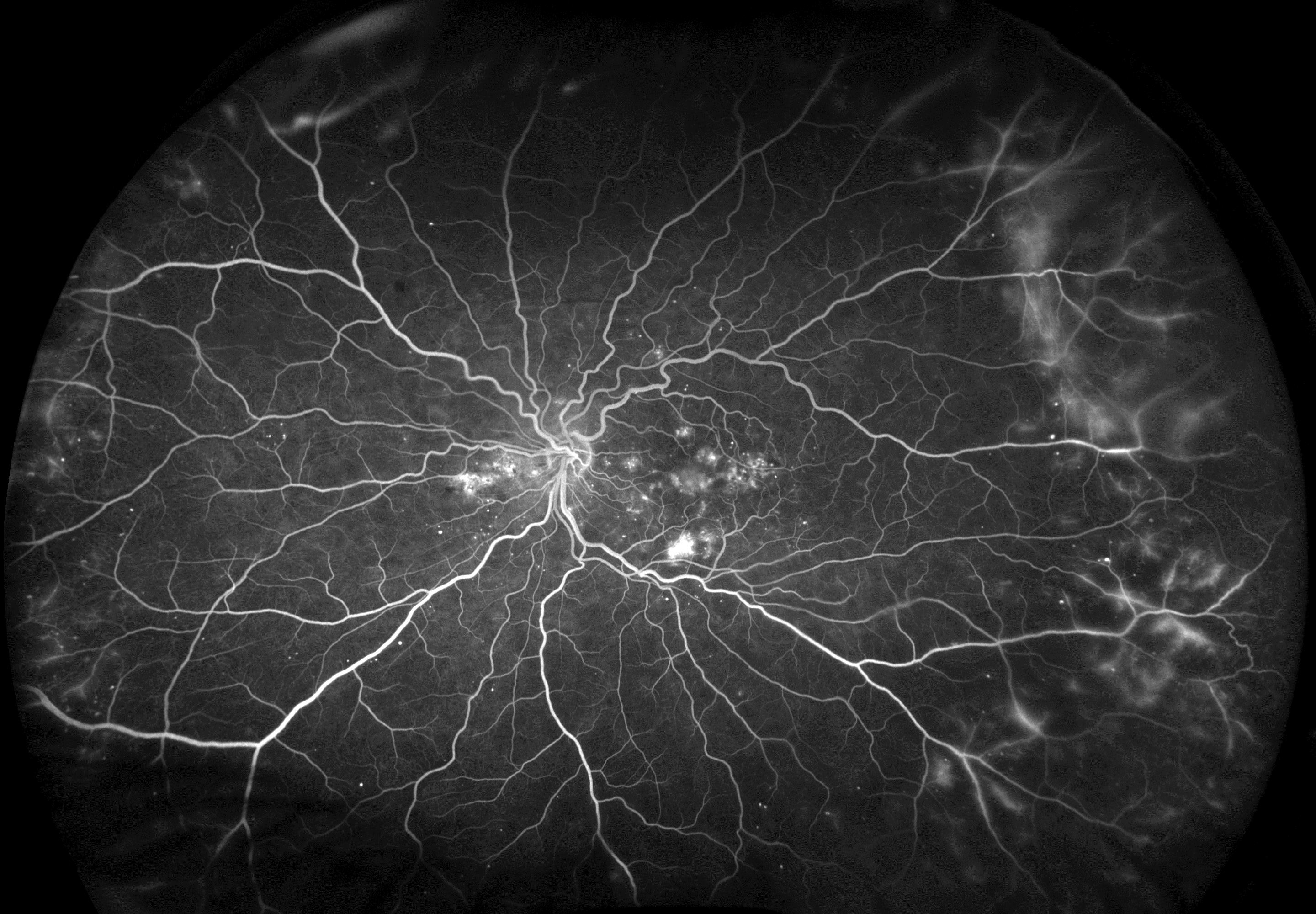 optomap fa image exhibiting both Wet AMD and Non-Proliferative Diabetic Retinopathy