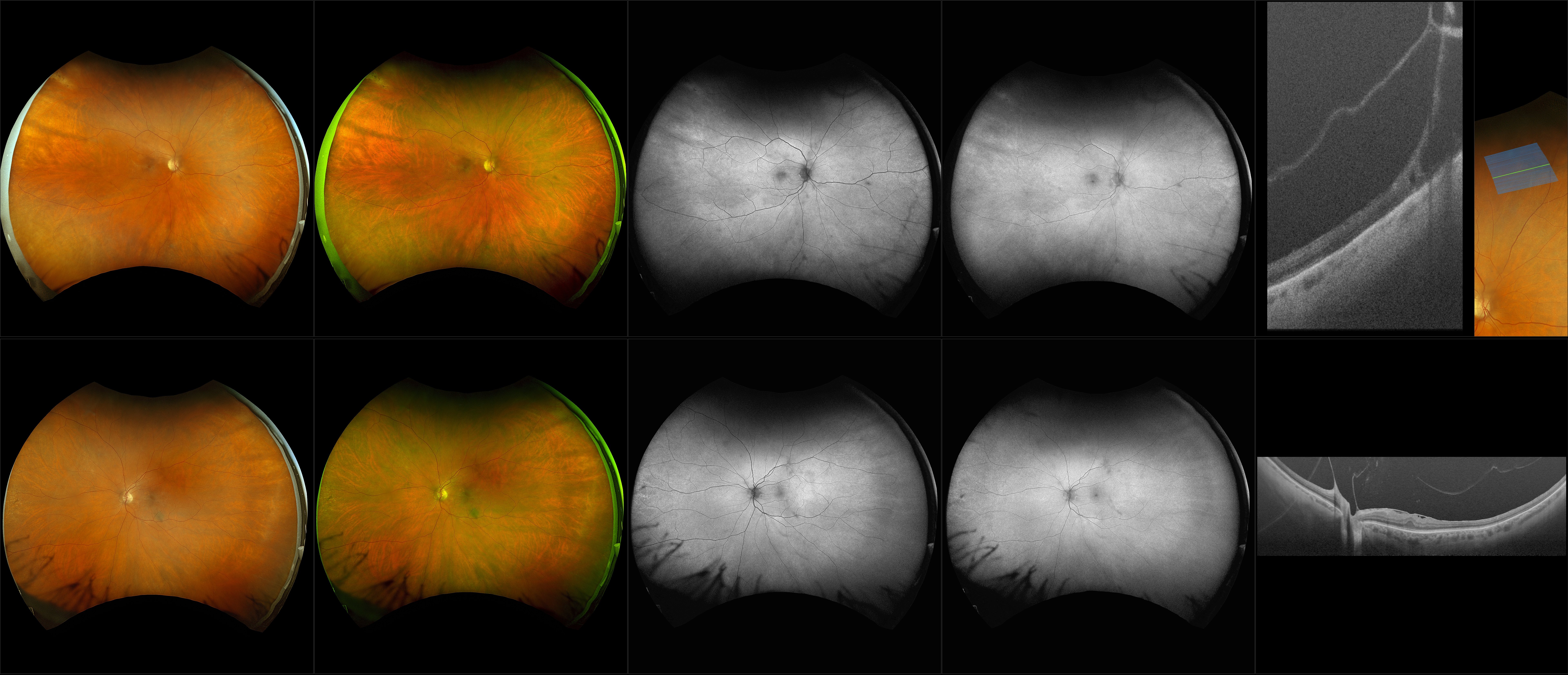 Silverstone - Degenerative Retinoschisis, Epiretinal Membrane, 2+ Nuclear Sclerosis Cataract (OU), Choroidal Nebvus (OS) - RG, RGB, AF, BAF, OCT - Line, UWF Line, Raster, Retina, Navigated Line, Navigated Volume