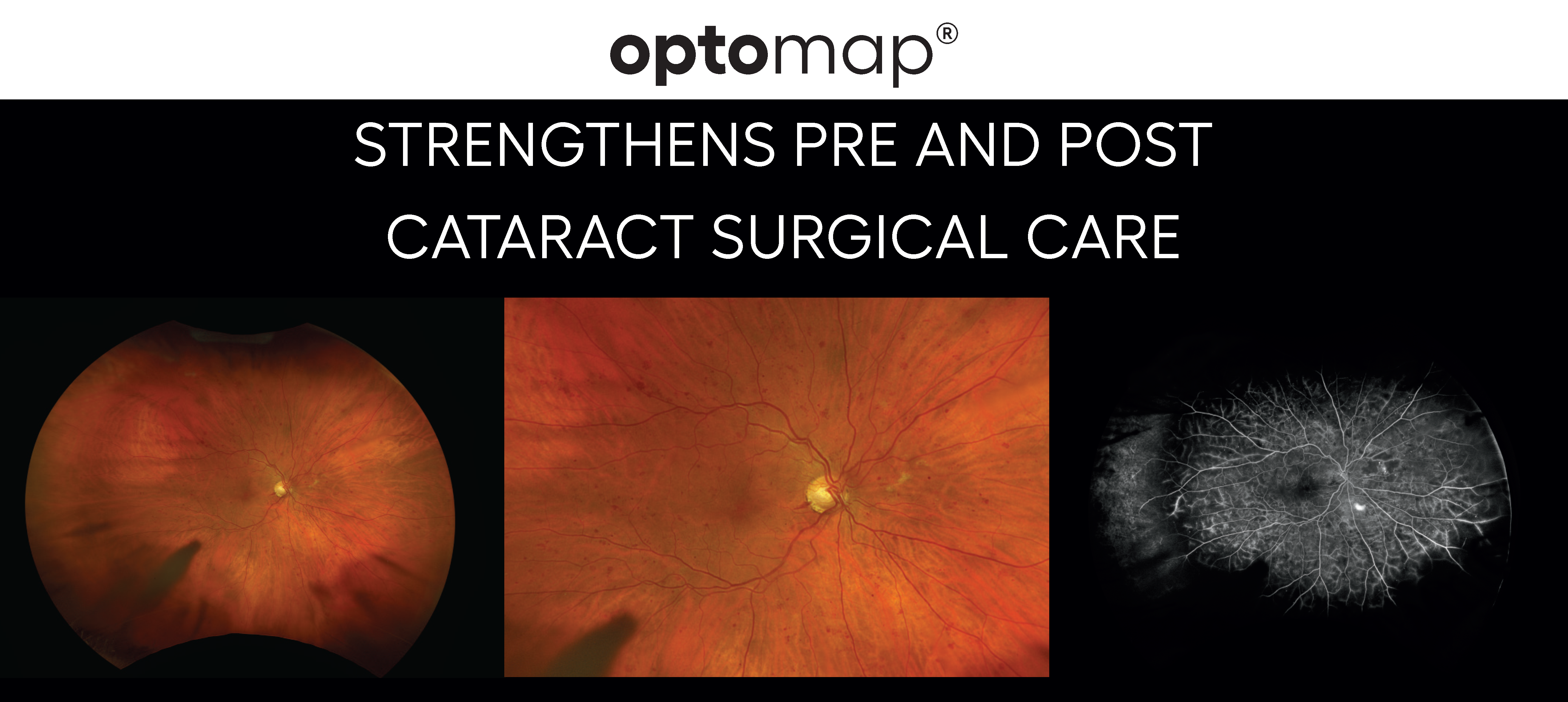 optomap cataract
