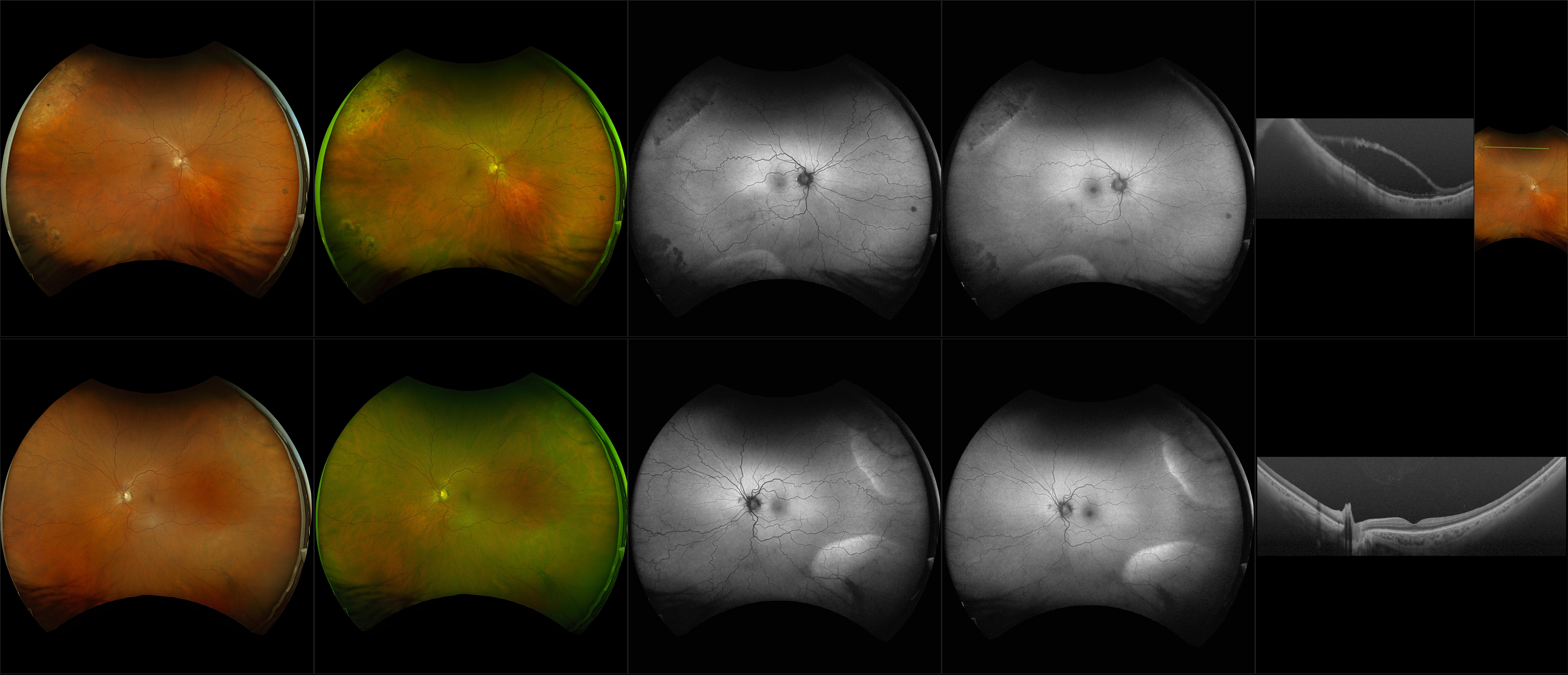 Silverstone - Degenerative Retinoschisis, 1+ Cortical Cataract (OU) - RG, RGB, AF, BAF, OCT - Line, UWF Line, Raster, Retina, ONH, Navigated Line, Navigated Volume
