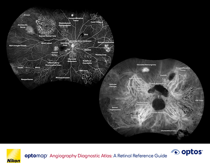 Diagnostic Atlas Booklet – optomap Angiography