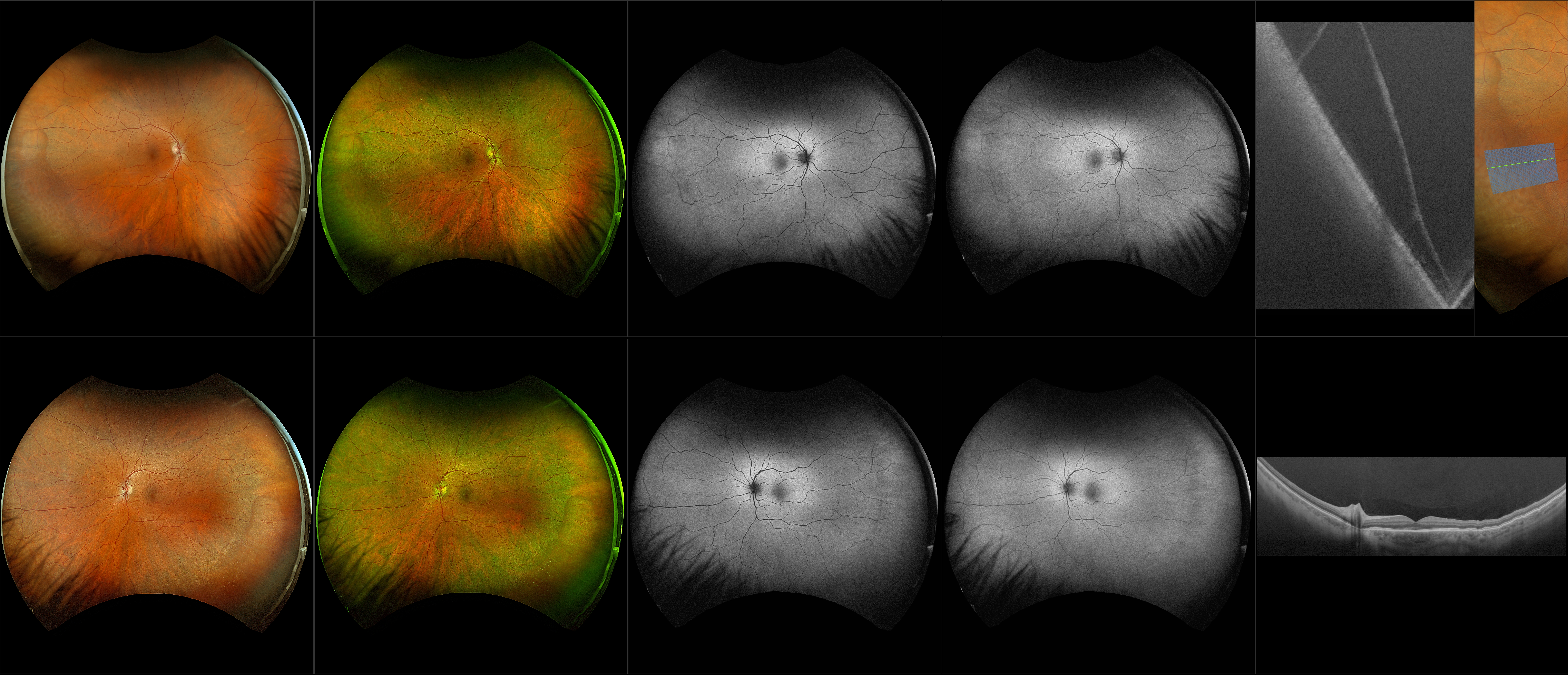 Silverstone Degenerative Retinoschisis OU RG RB AF BAF OCT 