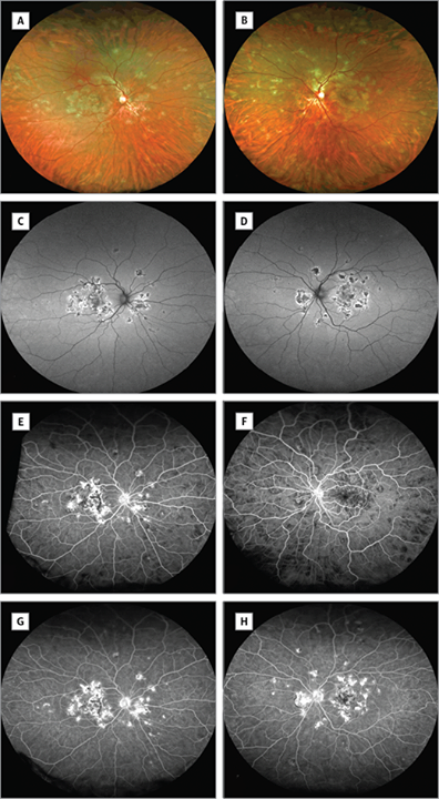 UWF retinal images