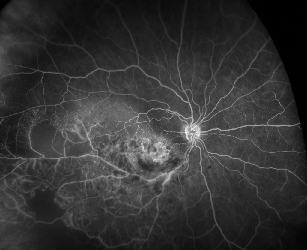 Branch retinal vein occlusion (BRVO) FA