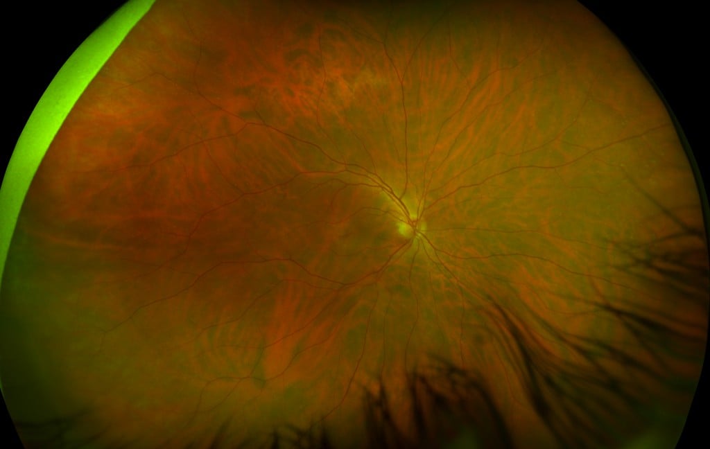 UWF color image of Central Serous Chorioretinopathy - California