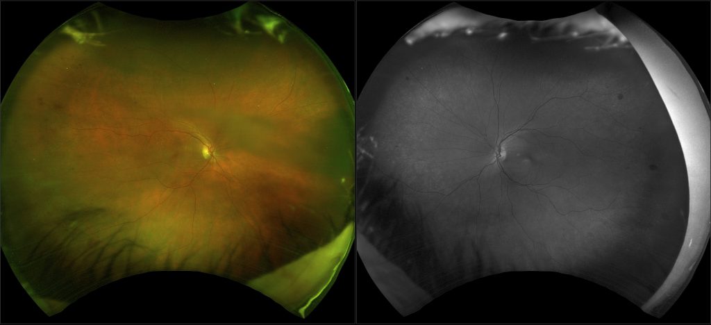 pre-surgical cataract exam; optomap imaging (color and sensory view) reveals early Diabetic Retinopathy evident as multiple dot hemorrhages