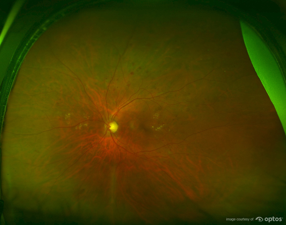 ultra-widefield image showing diabetic retinopathy