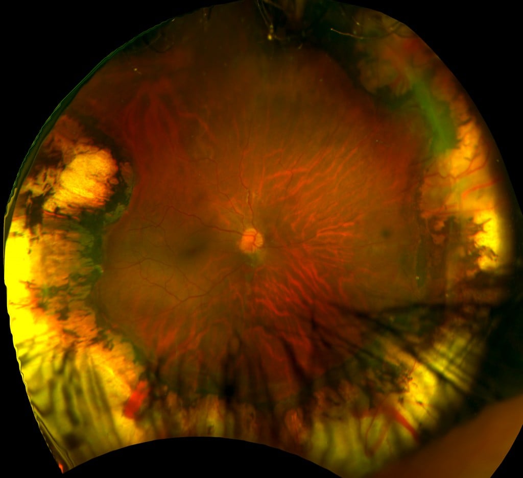 Retinopathy of Prematurity - Daytona