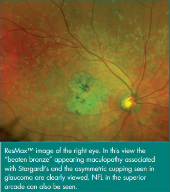 ultra-widefield retinal imaging