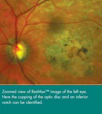UWF retinal imaging technology