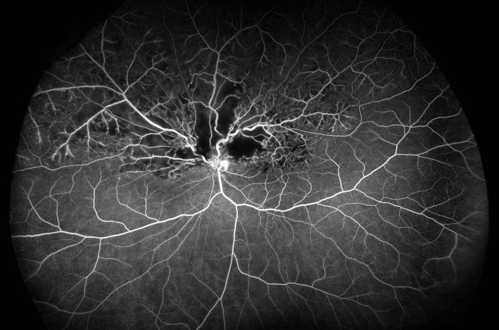 Hemi Retinal Vein Occlusion FA, California