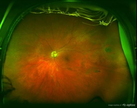 UWF retinal imaging