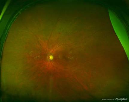 UWF retinal imaging