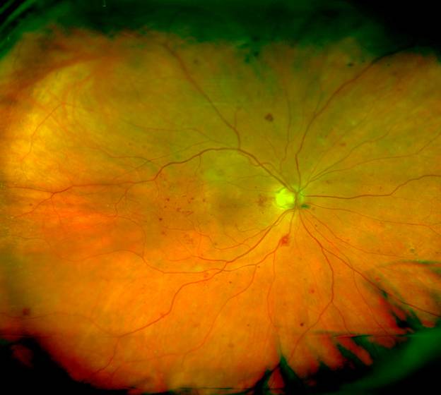 Diabetic retinopathy as shown in an optomap® ultra-widefield retinal image. 