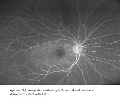 UWF retinal image