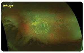 Ultra-widefield retinal images of retinitis pigmentosa