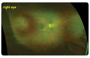 UWF images of pediatric retinitis pigmentosa
