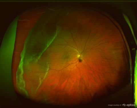 optomap retinal image