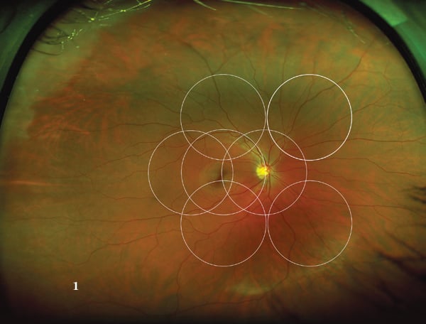 image captured by an Optos 200Tx scanning laser ophthalmoscope