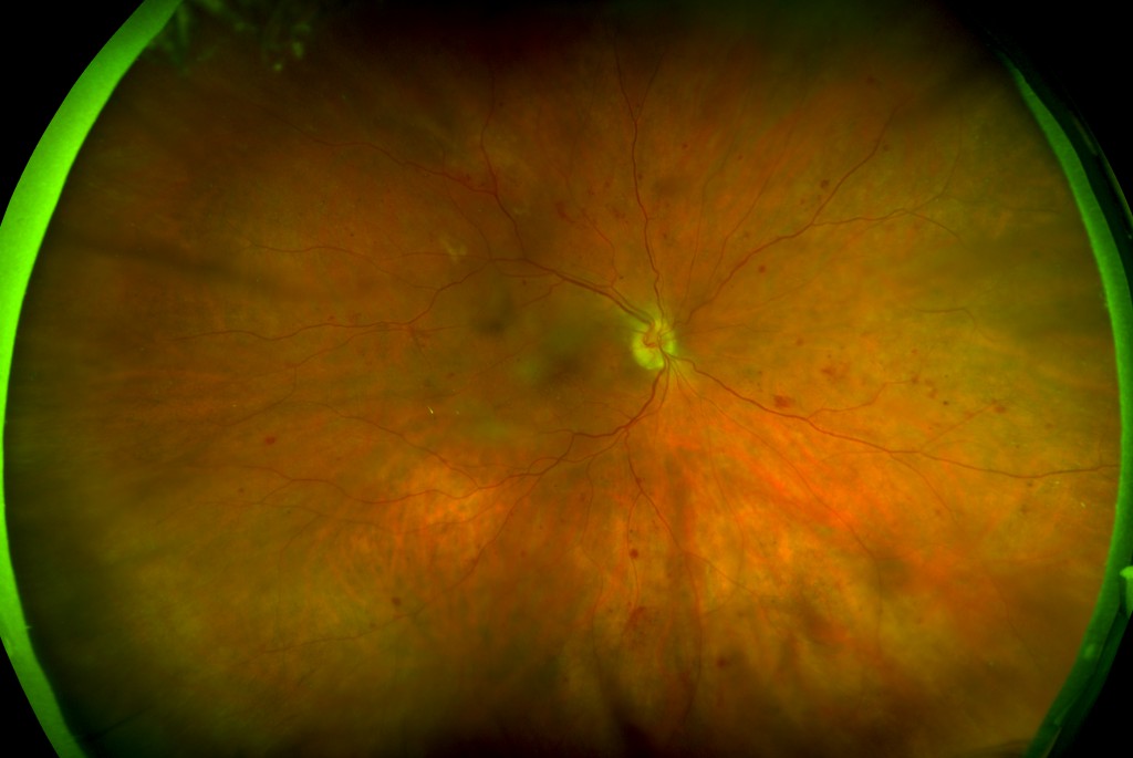 Image of proliferative diabetic retinopathy (DR) captured with the California