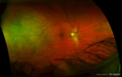 optomap ultra-widefield retinal image