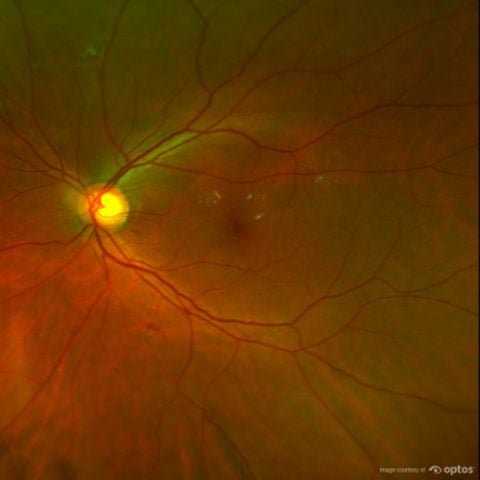 ultra-widefield retinal imaging