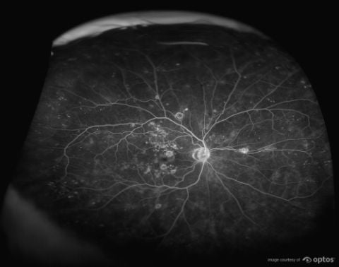 optomap retinal imaging