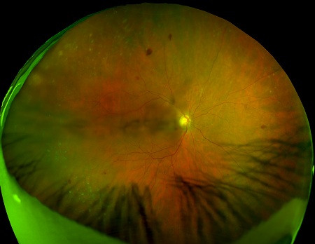 retinal imaging 