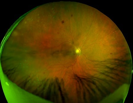 retinal imaging 