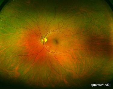 retinal image 