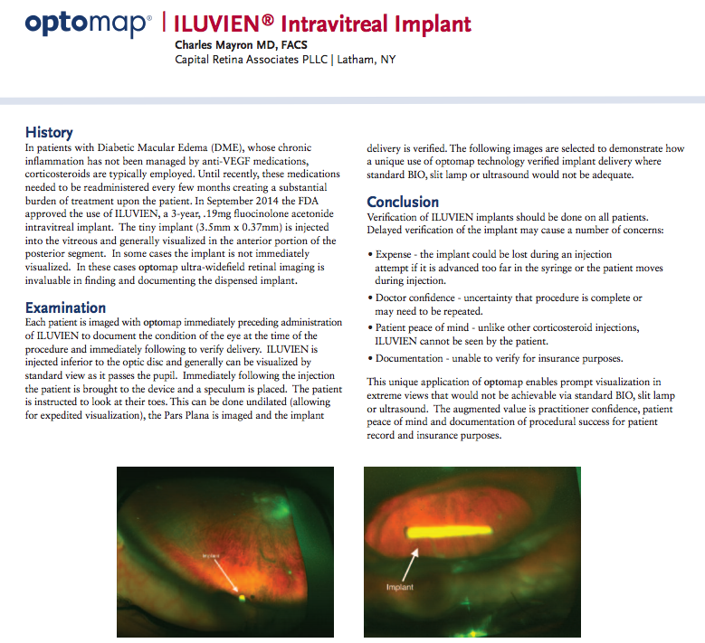 ILUVIEN® Intravitreal Implant, Charles Mayron MD, FACS Capital Retina Associates PLLC