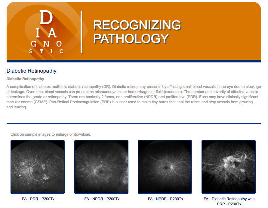 dibetic retinopathy
