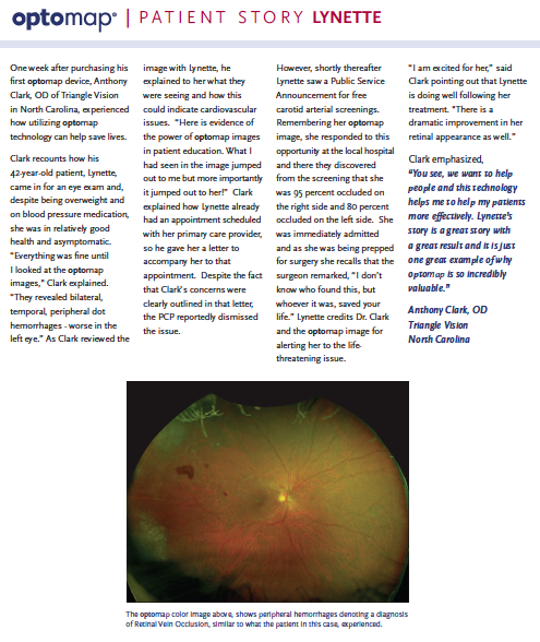 The optomap color image above, shows peripheral hemorrhages denoting a diagnosis of Retinal Vein Occlusion, similar to what the patient in this case, experienced.