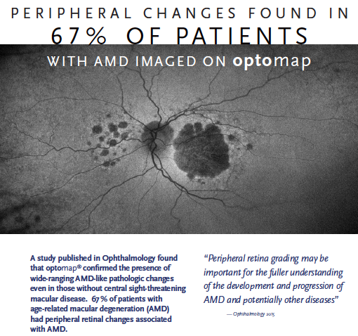 peripheral changes found in 67% of patients with AMD imaged with optomap