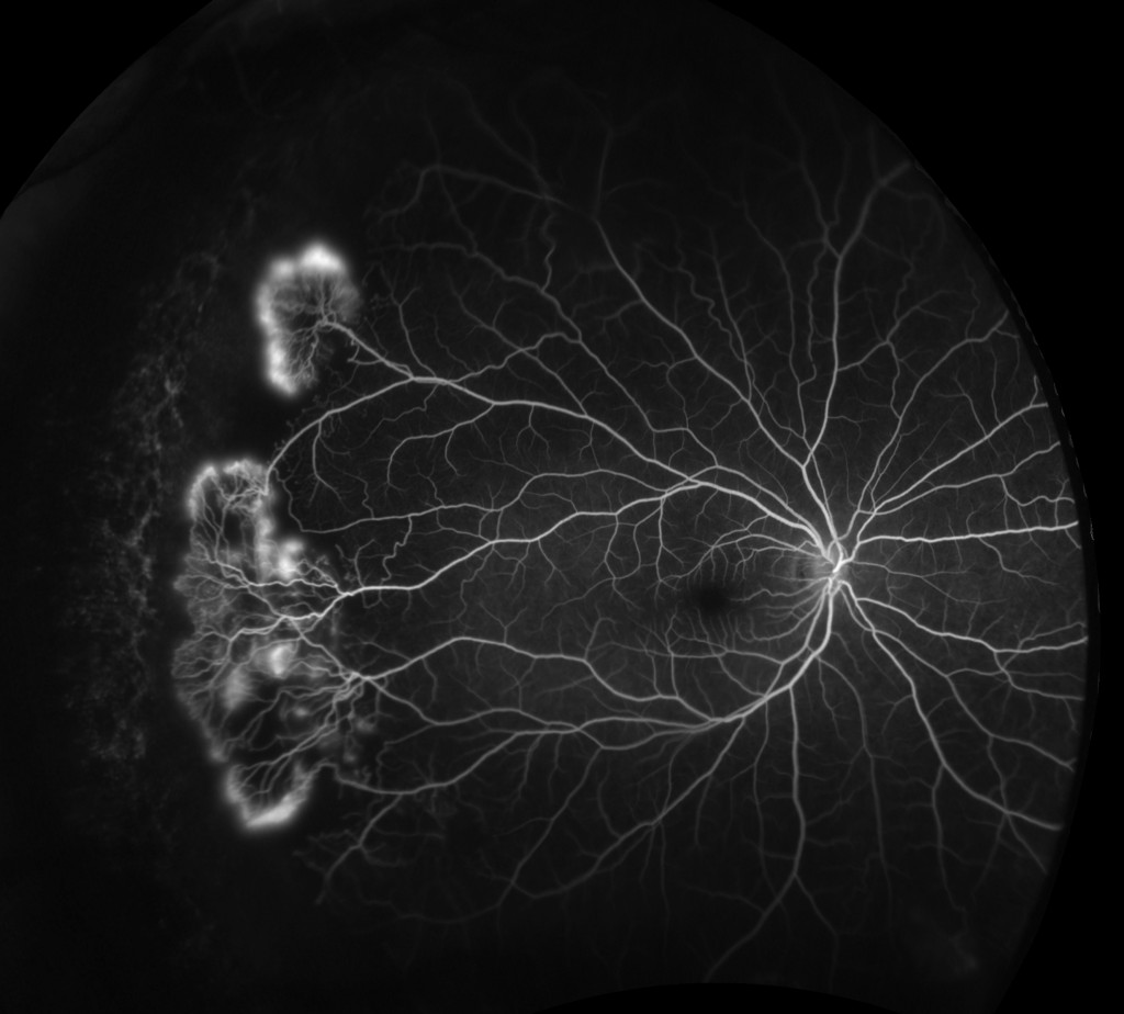 Sickle Cell Retinopathy FA