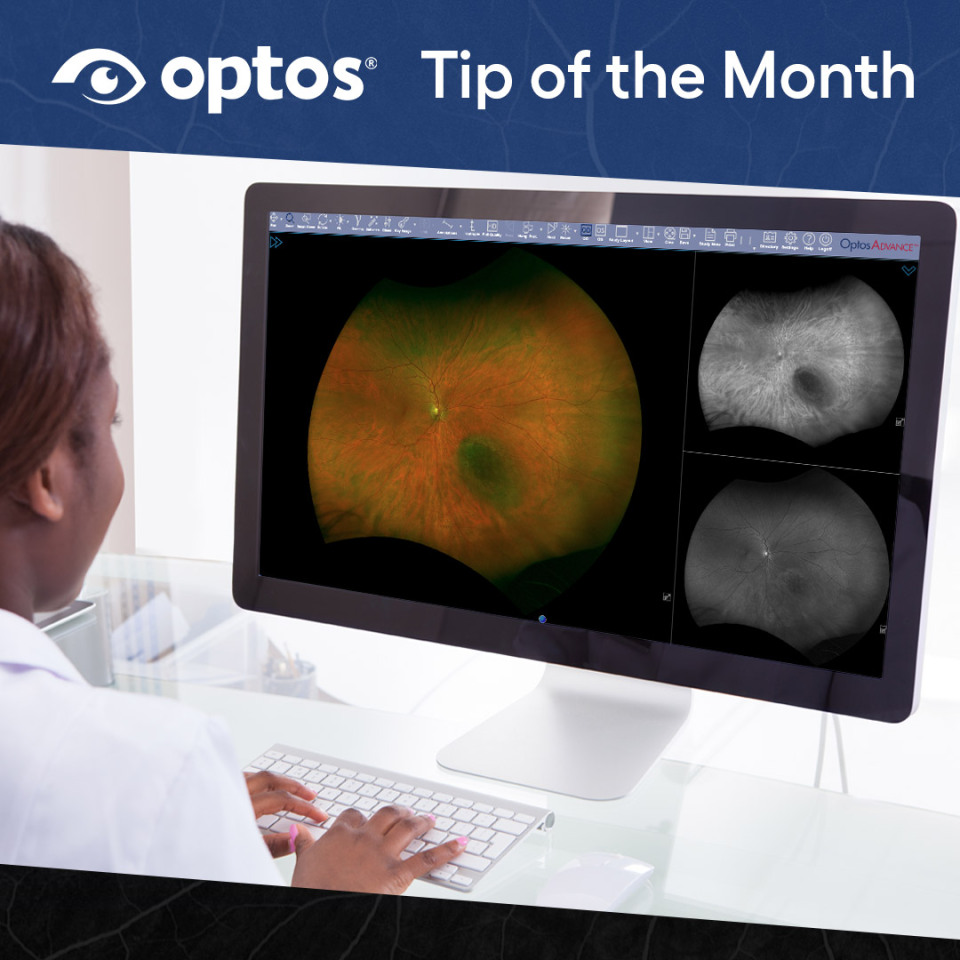 View Retinal Layers in OptosAdvance