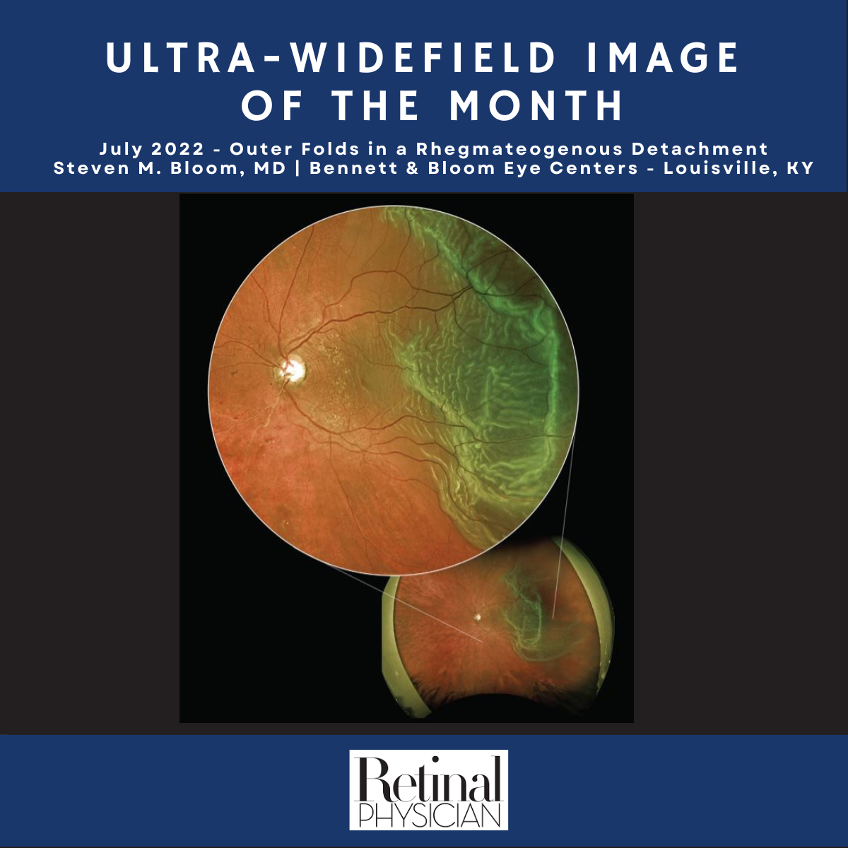 Outer Retinal Folds in Rhegmatogenous Retinal Detachment