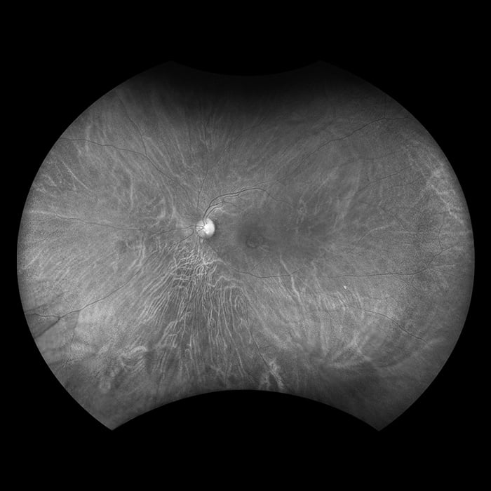 choroidal